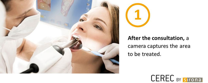 CEREC Dental Crown Step 1