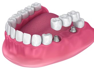 Implant Supported Bridge