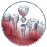 Dental Implants Icon