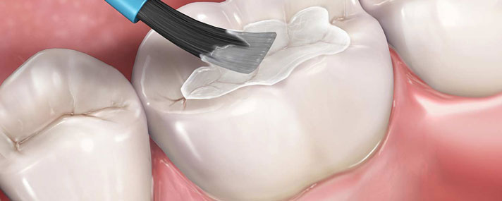 Dental Sealants Application