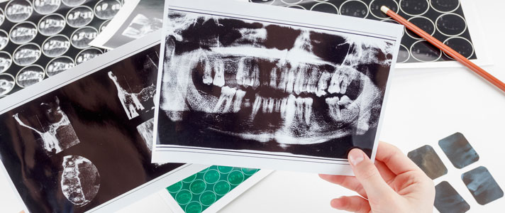 Dental XRay