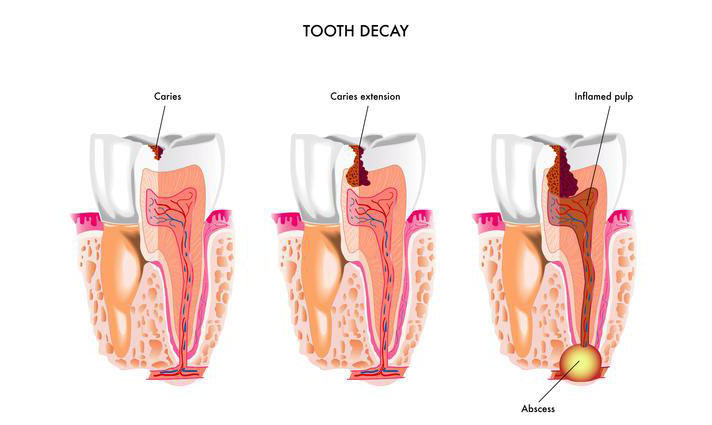 Infected Tooth Pulp
