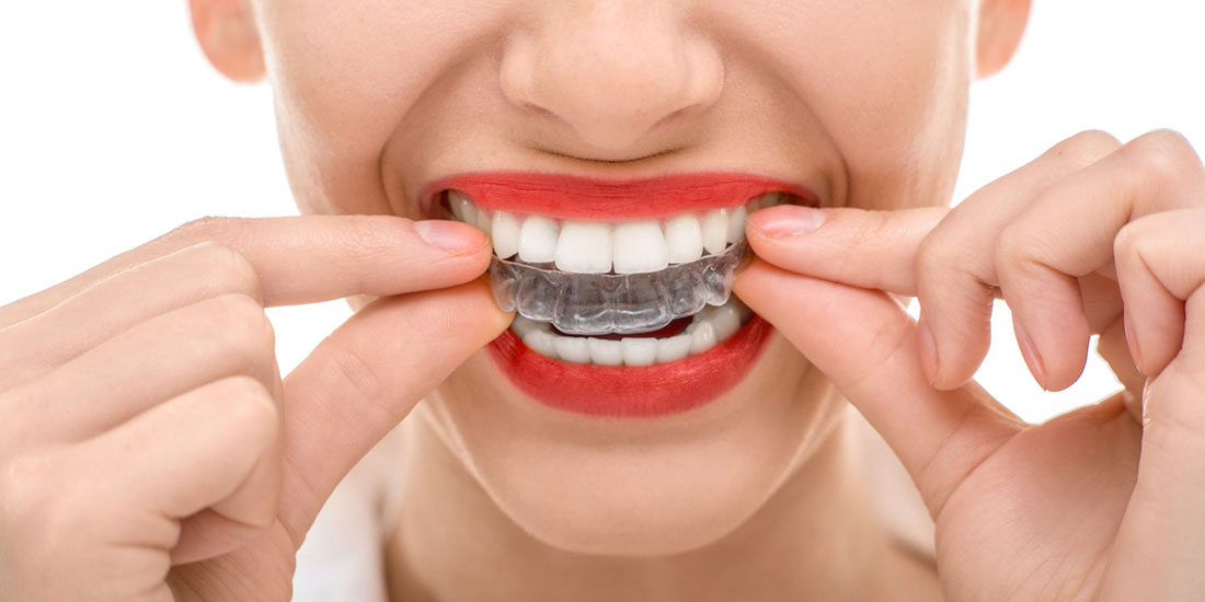 Invisalign Clear Aligner in Mouth