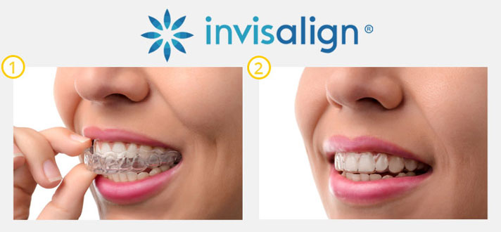 Invisalign Insturctions