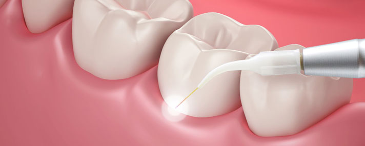 Laser Dentistry Illustration