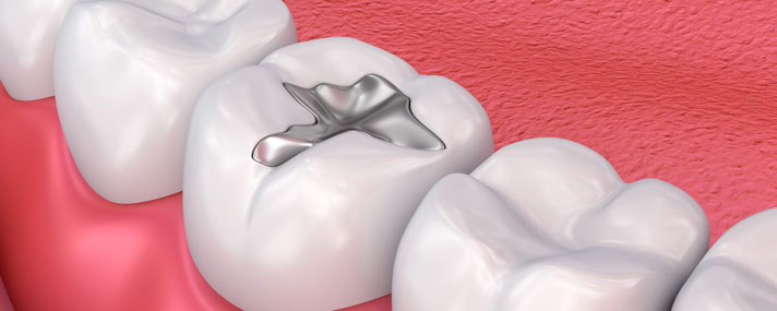 Silver Dental Filling