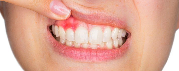 Red Swollen Gums