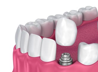Single Tooth Dental Implant