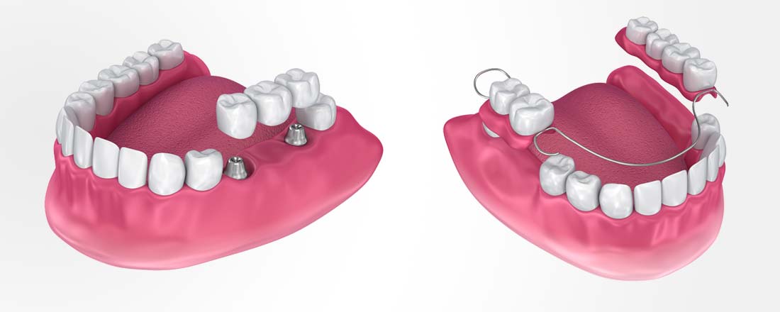 Types of Dental Bridges